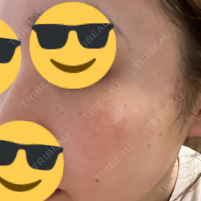 ピーリング（ハリ・ツヤ） / ルメッカ PureMe Skin Clinic（ピュアミースキンクリニック麻布） DAY 4 メイン用