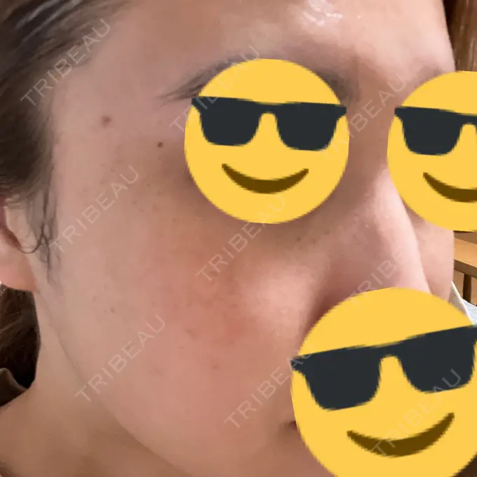 ピーリング（ハリ・ツヤ） / ルメッカ PureMe Skin Clinic（ピュアミースキンクリニック麻布） DAY 4 メイン用