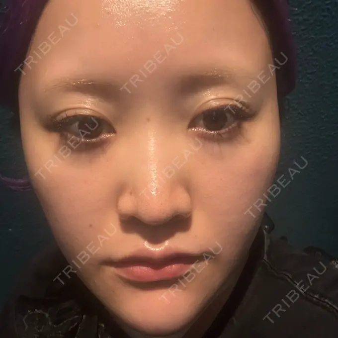 ルメッカ 東京美容外科 池袋院 DAY 1 メイン用