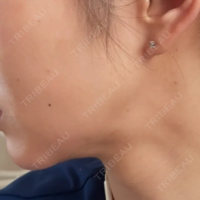 脂肪吸引（顔） / ジョールファット除去 / ボトックス（エラ・小顔） アリエル美容クリニック 大宮院 DAY 31 メイン用