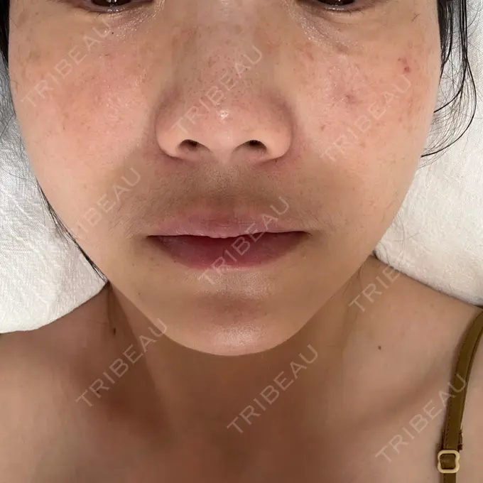 肌育注射（ジュベルックなど） ゆきスキンクリニック 東池袋 AFTER メイン用