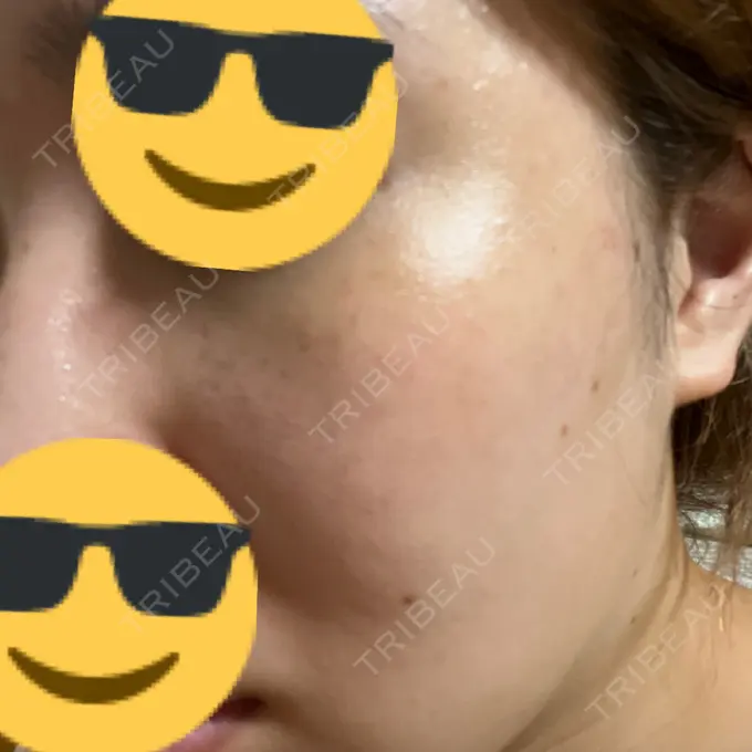 ピーリング（ハリ・ツヤ） / ルメッカ PureMe Skin Clinic（ピュアミースキンクリニック麻布） DAY 4 メイン用