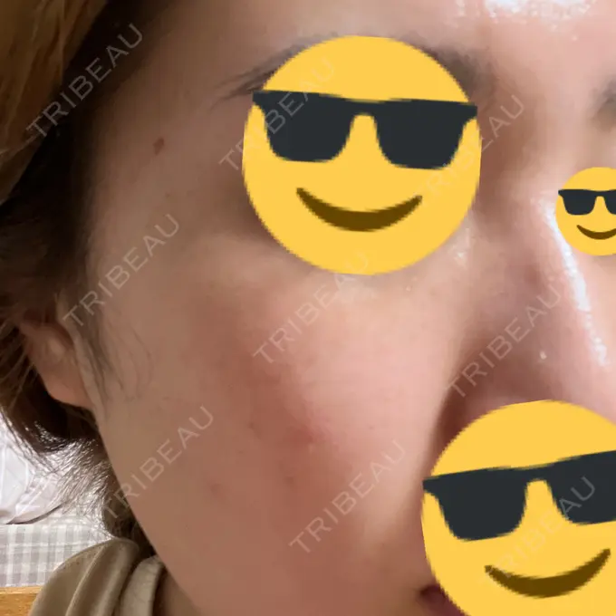 ピーリング（ハリ・ツヤ） / ルメッカ PureMe Skin Clinic（ピュアミースキンクリニック麻布） DAY 4 メイン用