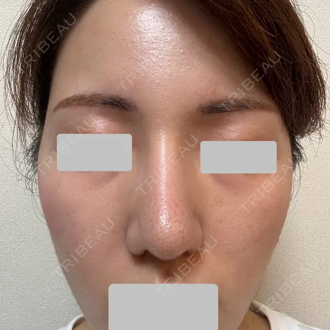 肌育注射（ジュベルックなど） Next Tokyo Clinic DAY 8 メイン用