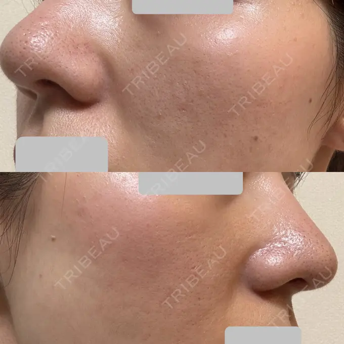 肌育注射（ジュベルックなど） Next Tokyo Clinic DAY 8 メイン用