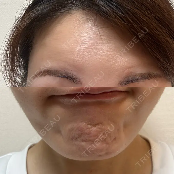 肌育注射（ジュベルックなど） Next Tokyo Clinic DAY 8 メイン用