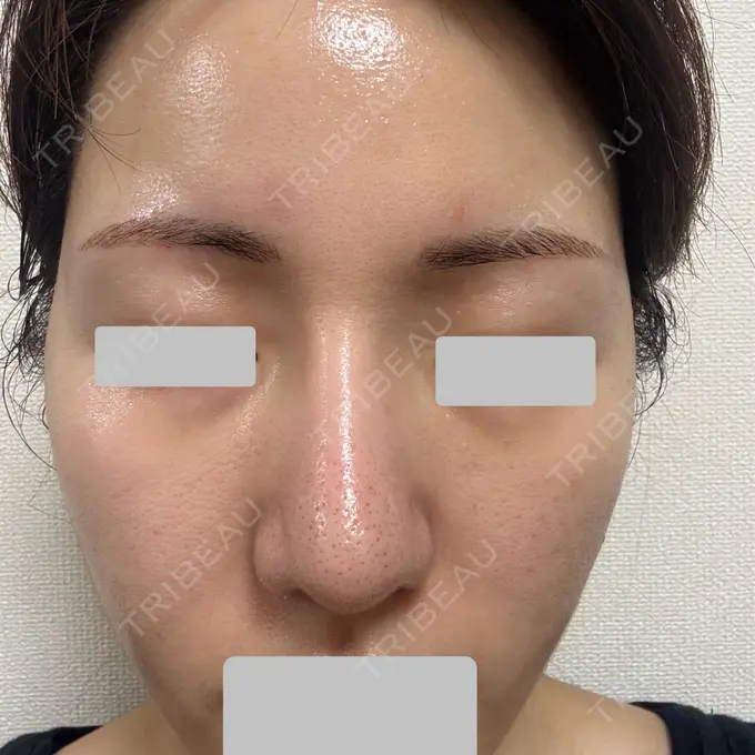 肌育注射（ジュベルックなど） Next Tokyo Clinic AFTER メイン用