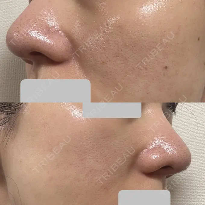 肌育注射（ジュベルックなど） Next Tokyo Clinic DAY 9 メイン用