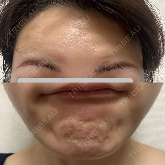 肌育注射（ジュベルックなど） Next Tokyo Clinic DAY 9 メイン用