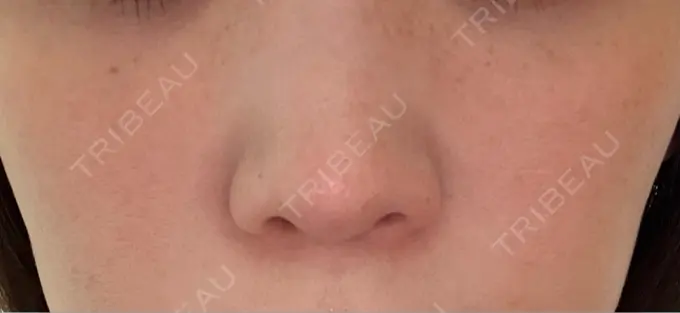 ピーリング（ハリ・ツヤ） / ルメッカ ルラ美容クリニック 仙台院 / ルラスキンクリニック 仙台院 AFTER メイン用