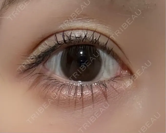 二重埋没 アリエル美容クリニック 横浜院 DAY 28 メイン用