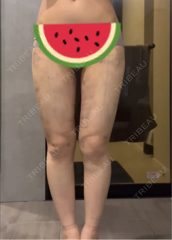 脂肪吸引（脚） / 脂肪吸引（お尻） Mods Clinic（モッズクリニック） 名古屋院 DAY 3 メイン用