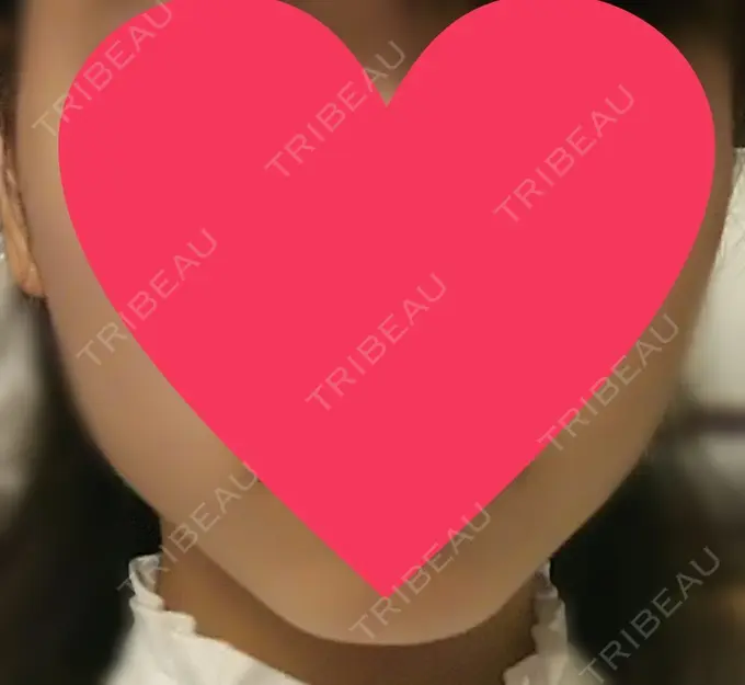 ハイフ（顔） 赤坂プレミアクリニック DAY 1 メイン用