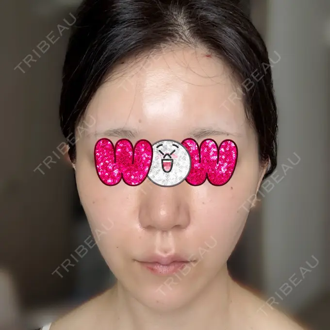 ヒアルロン酸注入（額） / ヒアルロン酸注入（頬） / ヒアルロン酸注入（鼻翼基部） KIMI CLINIC 形成・美容外科 DAY 0 メイン用