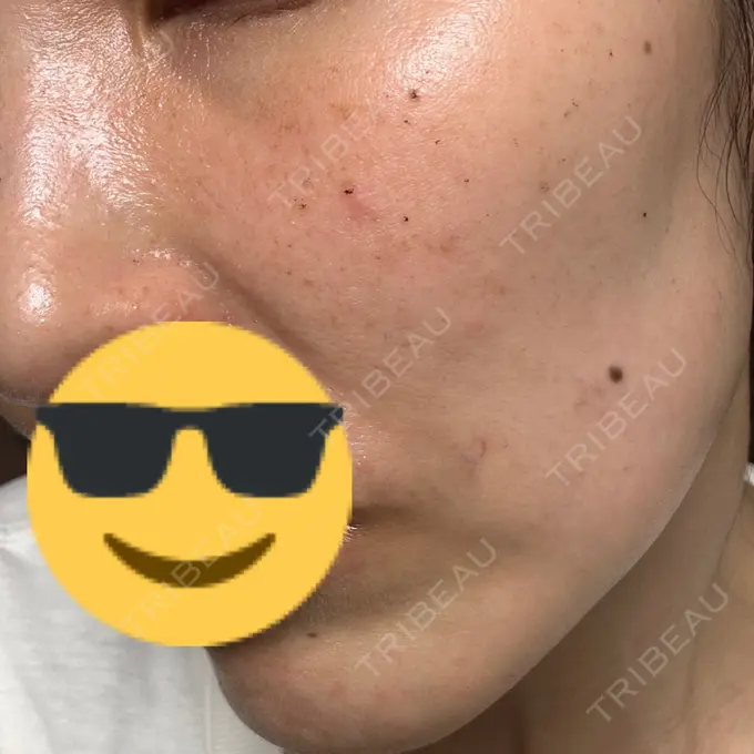 ルメッカ L‘amour clinic Tokyo【ラムールクリニック東京】 DAY 5 メイン用