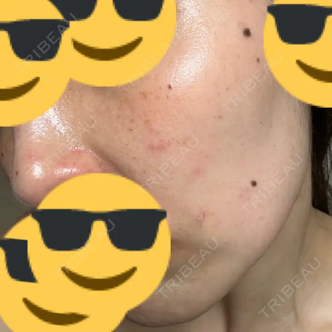 ルメッカ L‘amour clinic Tokyo【ラムールクリニック東京】 DAY 6 メイン用