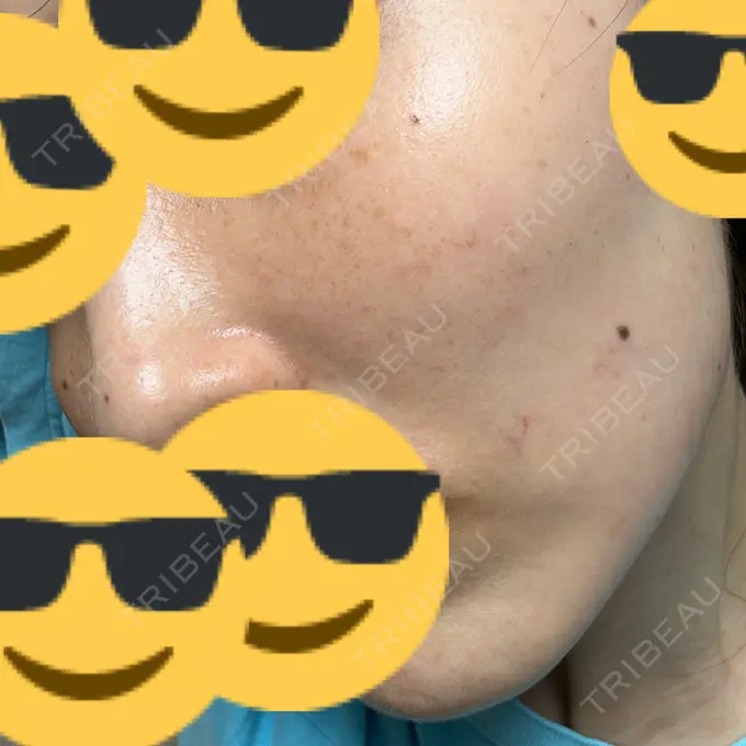 ルメッカ L‘amour clinic Tokyo【ラムールクリニック東京】 DAY 8 メイン用