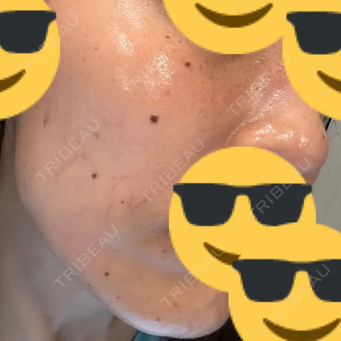 ルメッカ L‘amour clinic Tokyo【ラムールクリニック東京】 AFTER メイン用