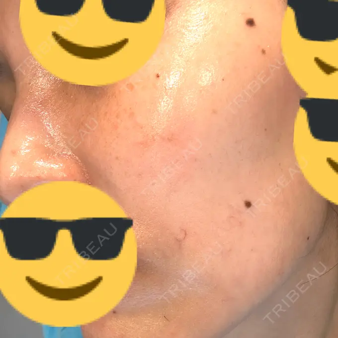 ルメッカ L‘amour clinic Tokyo【ラムールクリニック東京】 DAY 9 メイン用