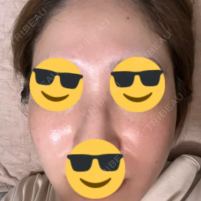 ピーリング（ハリ・ツヤ） / ルメッカ PureMe Skin Clinic（ピュアミースキンクリニック麻布） AFTER メイン用