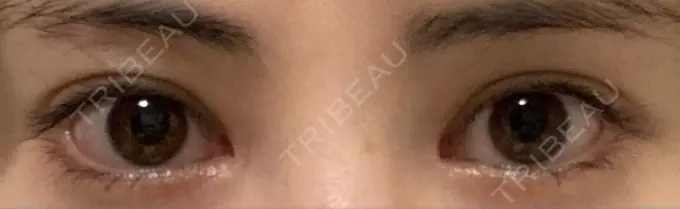 目頭切開 / 目尻切開 / 目尻靭帯移動 DIVINE（ディバイン）整形外科 DAY 88 メイン用