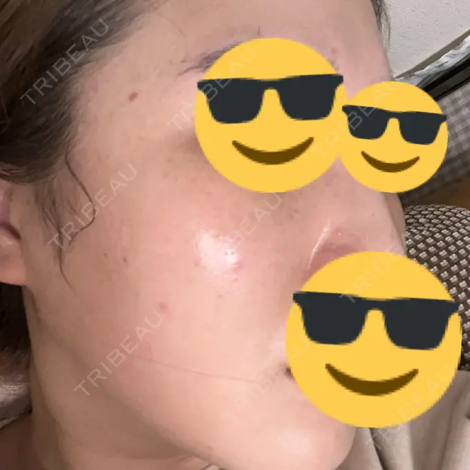 ピーリング（ハリ・ツヤ） / ルメッカ PureMe Skin Clinic（ピュアミースキンクリニック麻布） DAY 5 メイン用