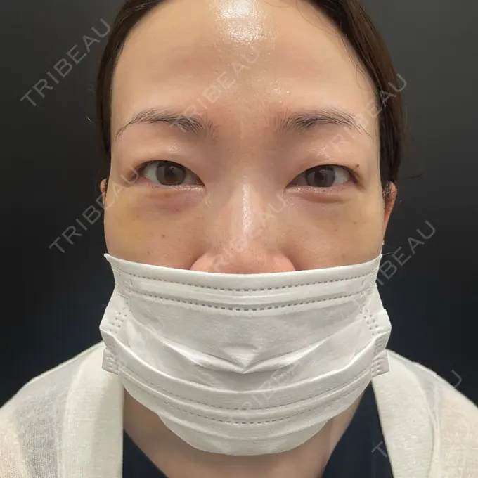 クマ治療 eクリニック 大阪院 DAY 7 メイン用