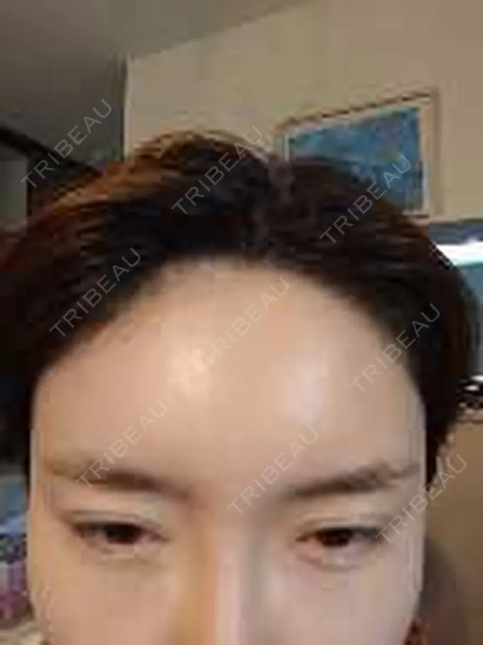 ボトックス（エラ・小顔） / ボトックス（肩） / ボトックス（眉間） / ボトックス（首） Natural Skin Clinic 自由ヶ丘院 DAY 11 メイン用