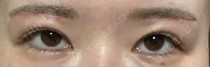 眉下切開 / ボトックス（眉間） / ボトックス（額） 銀座リシェスクリニック DAY 31 メイン用