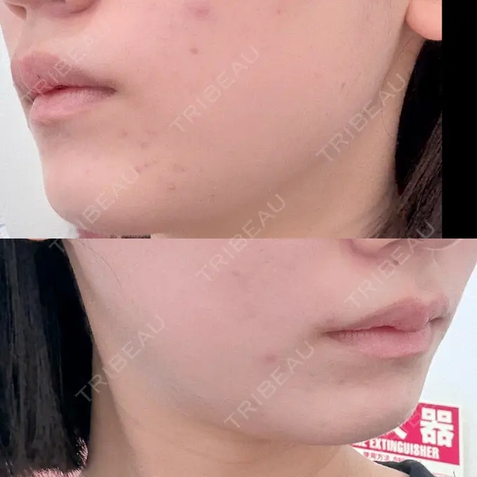 ボトックス（エラ・小顔） 東京シンデレラ美容外科 池袋院 AFTER メイン用