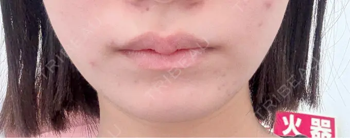 ボトックス（エラ・小顔） 東京シンデレラ美容外科 池袋院 DAY 58 メイン用