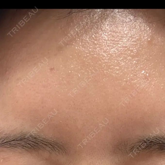 ボトックス（あご） / ボトックス（口角） / ボトックス（眉間） / ボトックス（額） TCB東京中央美容外科 静岡院 AFTER メイン用