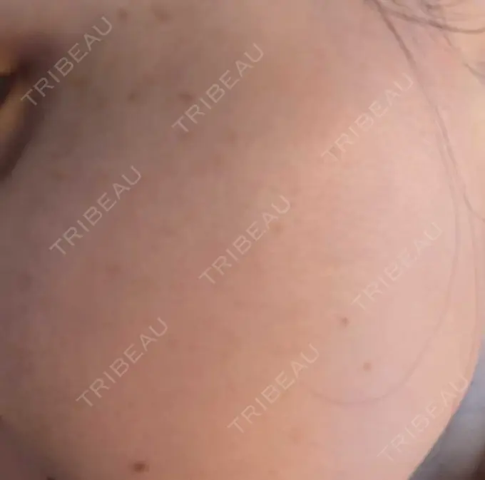 ボトックス（エラ・小顔） / ピーリング（ニキビ・毛穴） アリエル美容クリニック 横浜院 DAY 0 メイン用