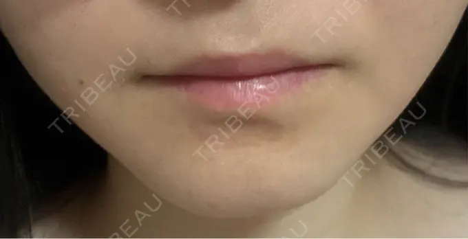 シワ取りボトックス / その他（輪郭） PRISM Beauty Clinic 町田院 DAY 36 メイン用