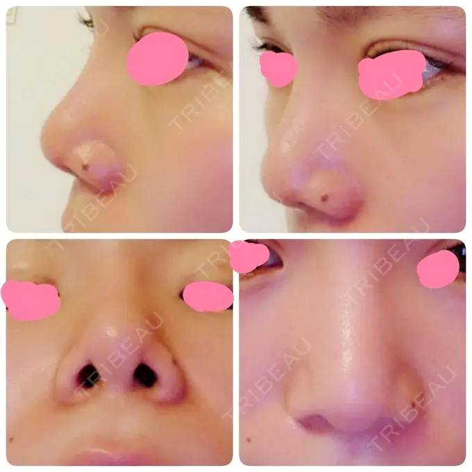 隆鼻術 / 鼻尖形成（切開） / 鼻尖縮小 ヤスミクリニック DAY 42 メイン用