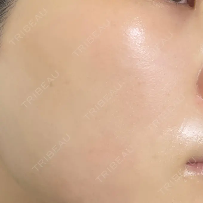 ルビーレーザー AZ BEAUTY CLINIC AFTER メイン用