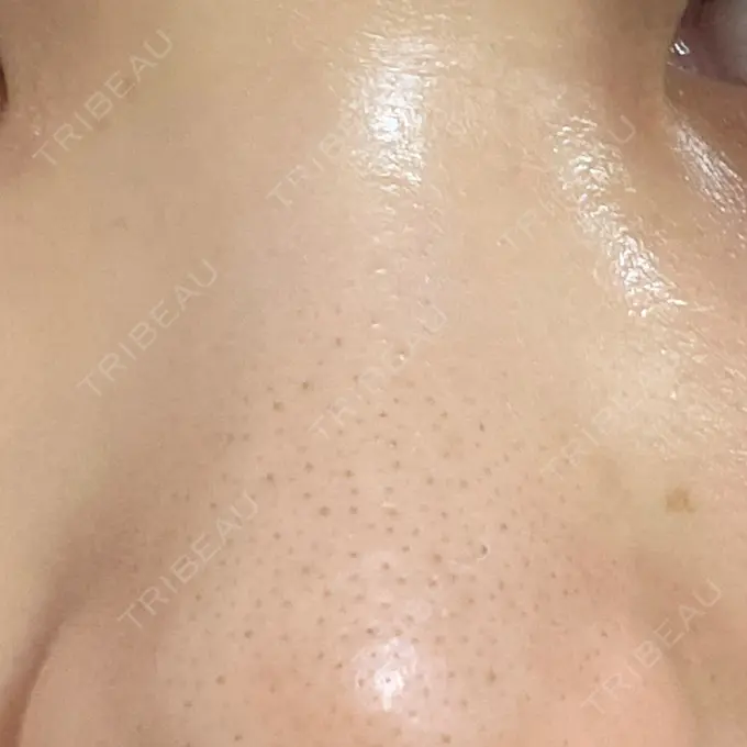 ルビーレーザー AZ BEAUTY CLINIC DAY 14 メイン用