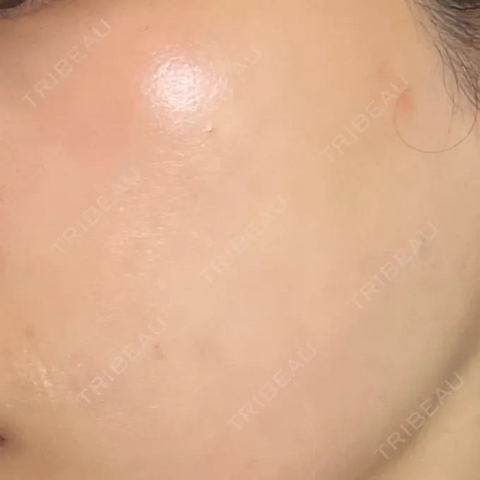 ルビーレーザー AZ BEAUTY CLINIC DAY 14 メイン用