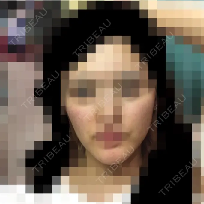 再生医療 / ニキビ治療 ニューセンス皮膚科クリニック DAY 15 メイン用