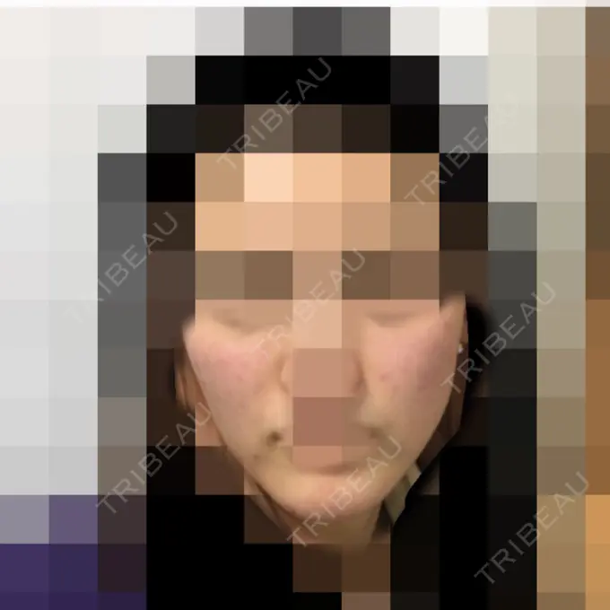 再生医療 / ニキビ治療 ニューセンス皮膚科クリニック DAY 6 メイン用