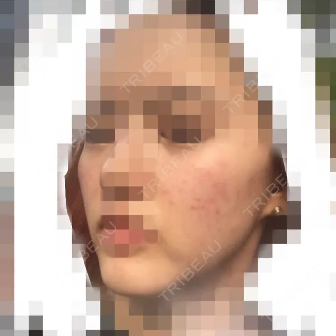 再生医療 / ニキビ治療 ニューセンス皮膚科クリニック DAY 3 メイン用