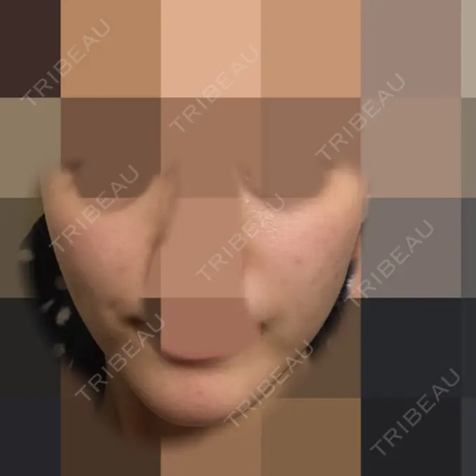 再生医療 / ニキビ治療 ニューセンス皮膚科クリニック DAY 7 メイン用