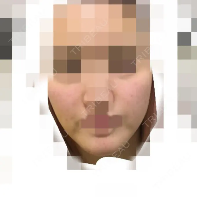 再生医療 / ニキビ治療 ニューセンス皮膚科クリニック DAY 9 メイン用