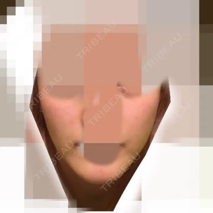 再生医療 / ニキビ治療 ニューセンス皮膚科クリニック DAY 17 メイン用