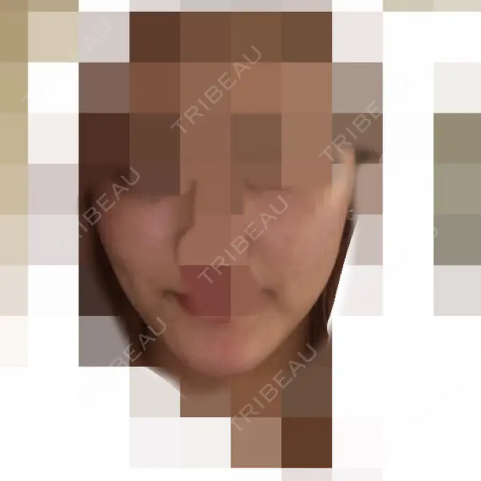 再生医療 / ニキビ治療 ニューセンス皮膚科クリニック DAY 21 メイン用