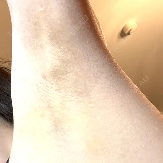 ワキ汗治療（レーザー） Fellez Clinic【フェルズクリニック】 AFTER メイン用