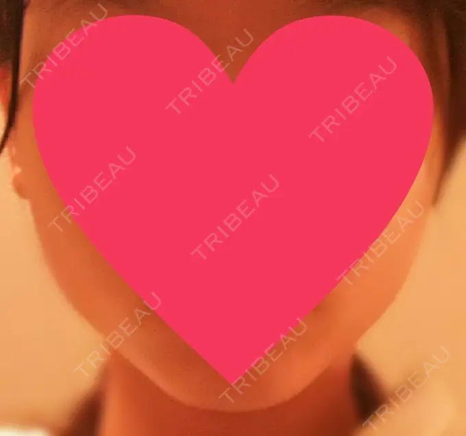 ハイフ（顔） 赤坂プレミアクリニック DAY 2 メイン用