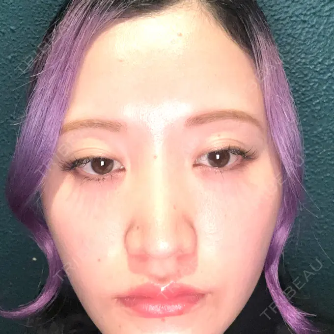 ルメッカ 東京美容外科 池袋院 DAY 5 メイン用