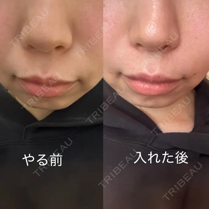 ヒアルロン酸注入（鼻翼基部） 大美会クリニック 心斎橋本院 AFTER メイン用