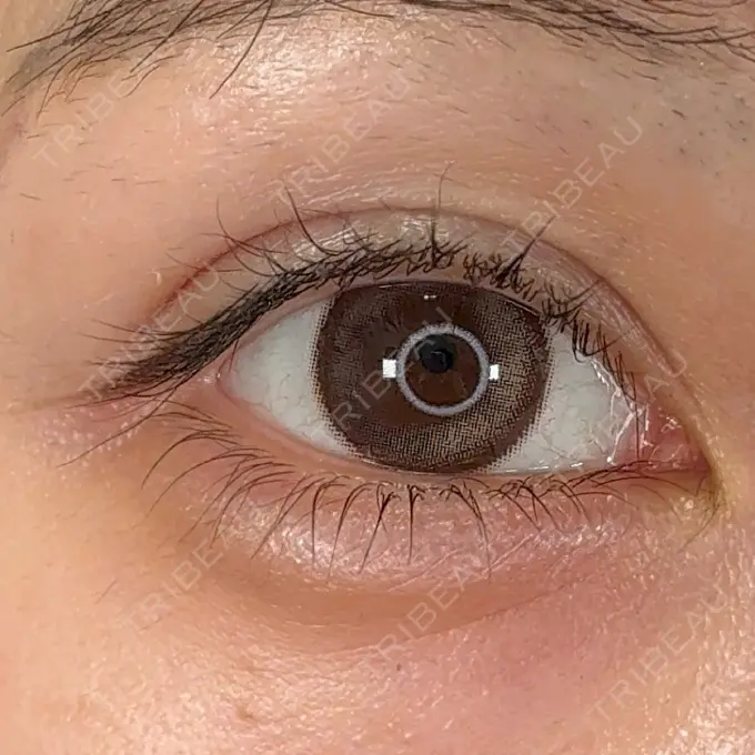 二重埋没 アリエル美容クリニック 横浜院 AFTER メイン用